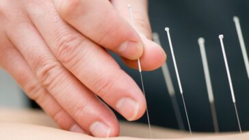 acupuncture therapy for pain relief